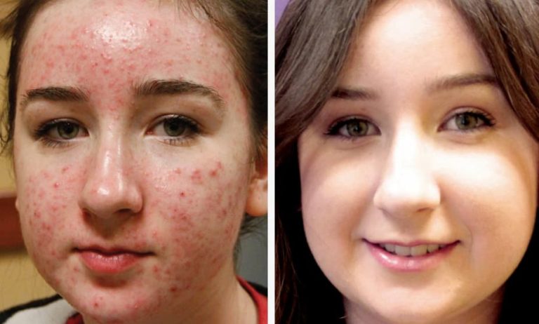 Acne & Acne Scar Treatment - Professional acne care and scar reduction
