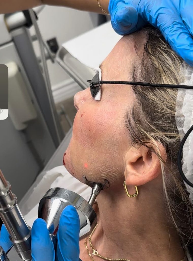Fractional Resurfacing - Advanced laser treatment for wrinkles and scars