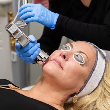 MicroLaserPeel - Laser skin resurfacing for improved texture and tone