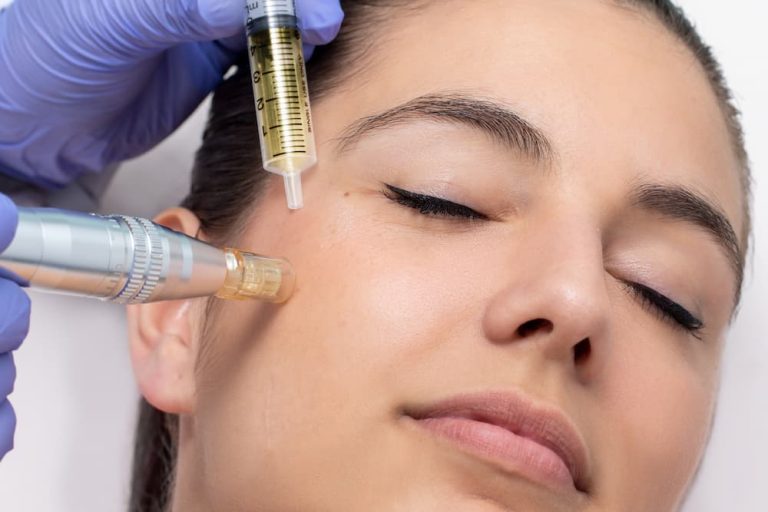 Microneedling with PRP - Platelet-rich plasma skin rejuvenation treatment